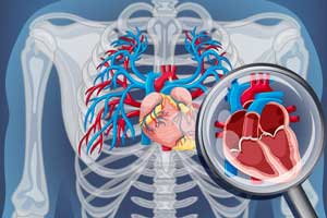 Coronary Angiography