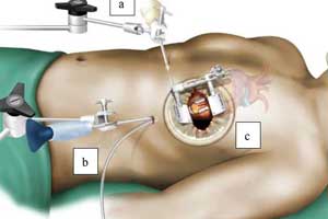 Minimally Invasive