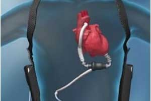 LVAD