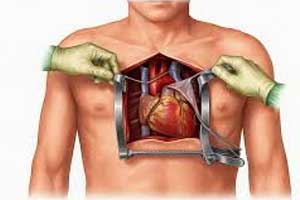 Open Heart Surgery