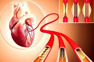 Angioplasty
