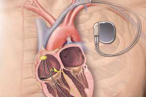 Pacemaker