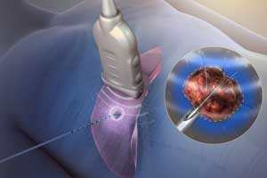 Radiofrequency Ablation