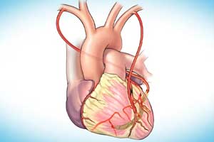 Redo Heart Surgery