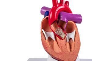 TAVR
