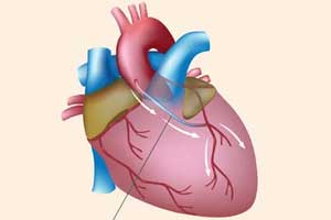 CABG Surgery