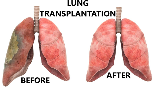 Lung transplant