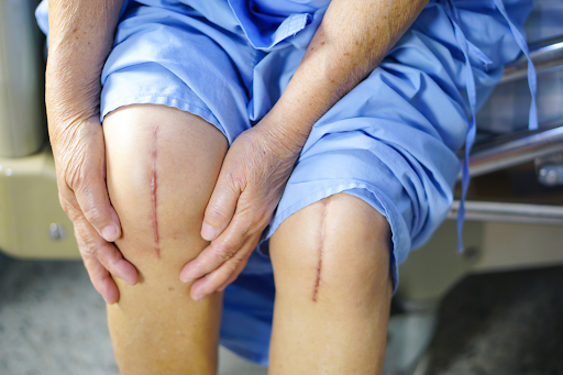 Top 10 Best Knee Replacement Surgery Hospitals in India