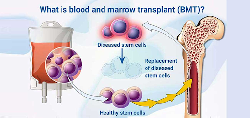 Pediatric Bone Marrow Transplant (BMT)with Cost - MyMedTrip